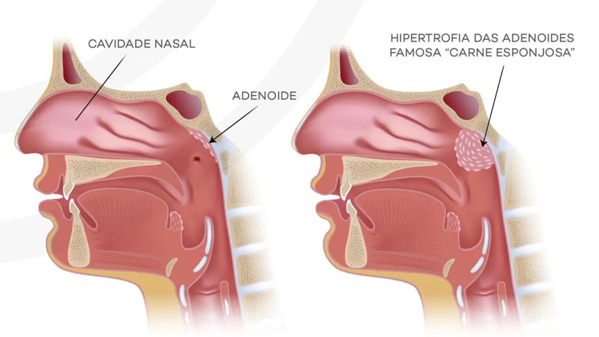 cirurgia para a remoção do tecido adenoidiano ou tonsila faríngea